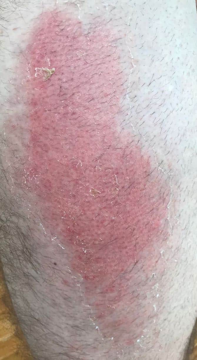 Gravel Rash Treatment Breathe Vélo